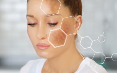 Ilumina tu rostro deshaciéndote de la melasma