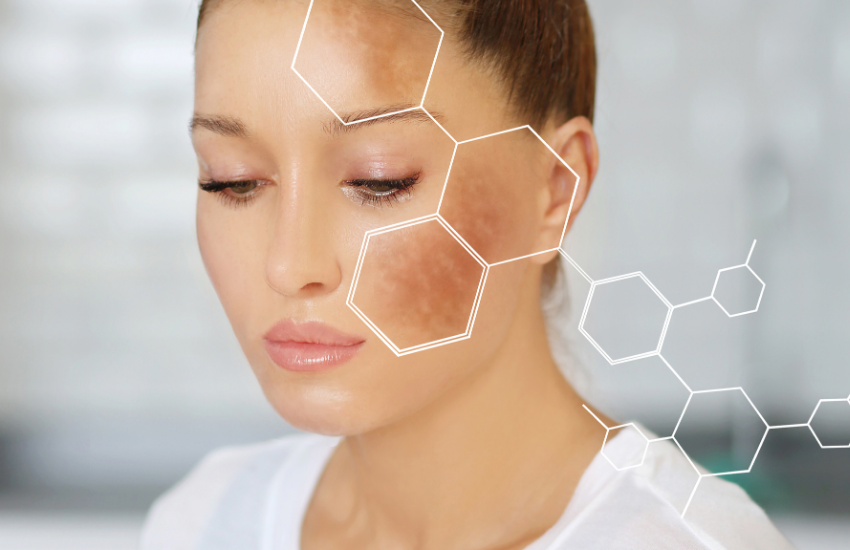 Ilumina tu rostro deshaciéndote de la melasma